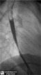 Eosinophilic Esophagitis